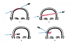 Огнестрельные ранения черепа и головного мозга: 1 – касательное; 2 – сквозное; 3 – слепое; 4 – рикошетирующее. И первый и четвертый варианты могут быть смертельными, а при втором и третьем человек может остаться жив. Все зависит от точки попадания и энергии пули